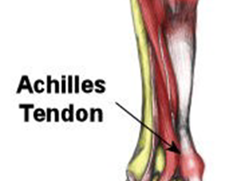 Achilles tendinopathy.png